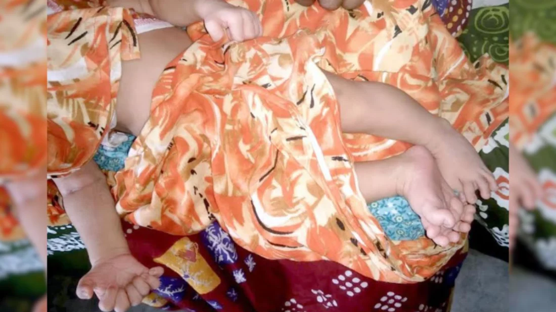 ফুলবাড়ীতে ২৮ আঙুল নিয়ে কন্যাশিশুর জন্ম